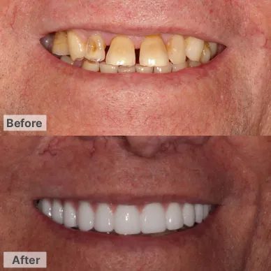 Before and After – Dentures & Implants