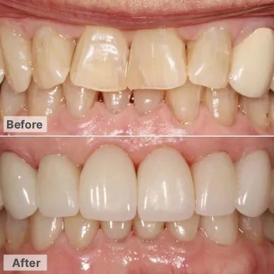 Before and After – Veneers