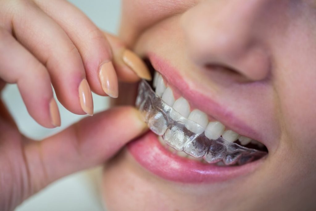 Clear Aligners in Phoenix, AZ