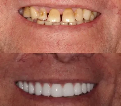 The before-and-after evolution of a smile through dental enhancement