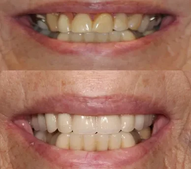Transformation of teeth through dental treatment