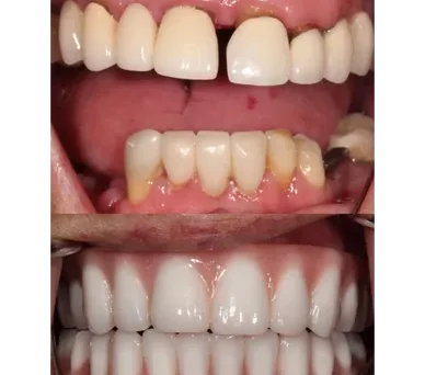 Enhanced dental aesthetics post successful Implant treatment