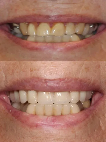 Smile showcasing the success of a dental implant treatment