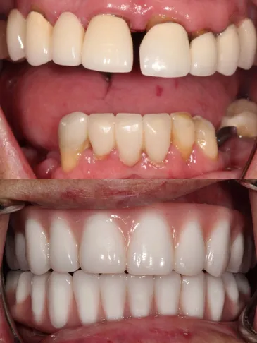 Before and After getting Dental Implants in Phoneix