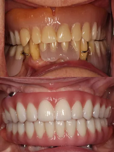 Patient's smile before and after getting dental treatment