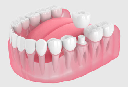 The Ultimate Guide to Selecting the Perfect Dental Crown for Sensitive Teeth
