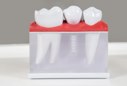 Is It Safe to Use Mouthwash after Dental Implants?