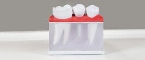 Is It Safe to Use Mouthwash after Dental Implants