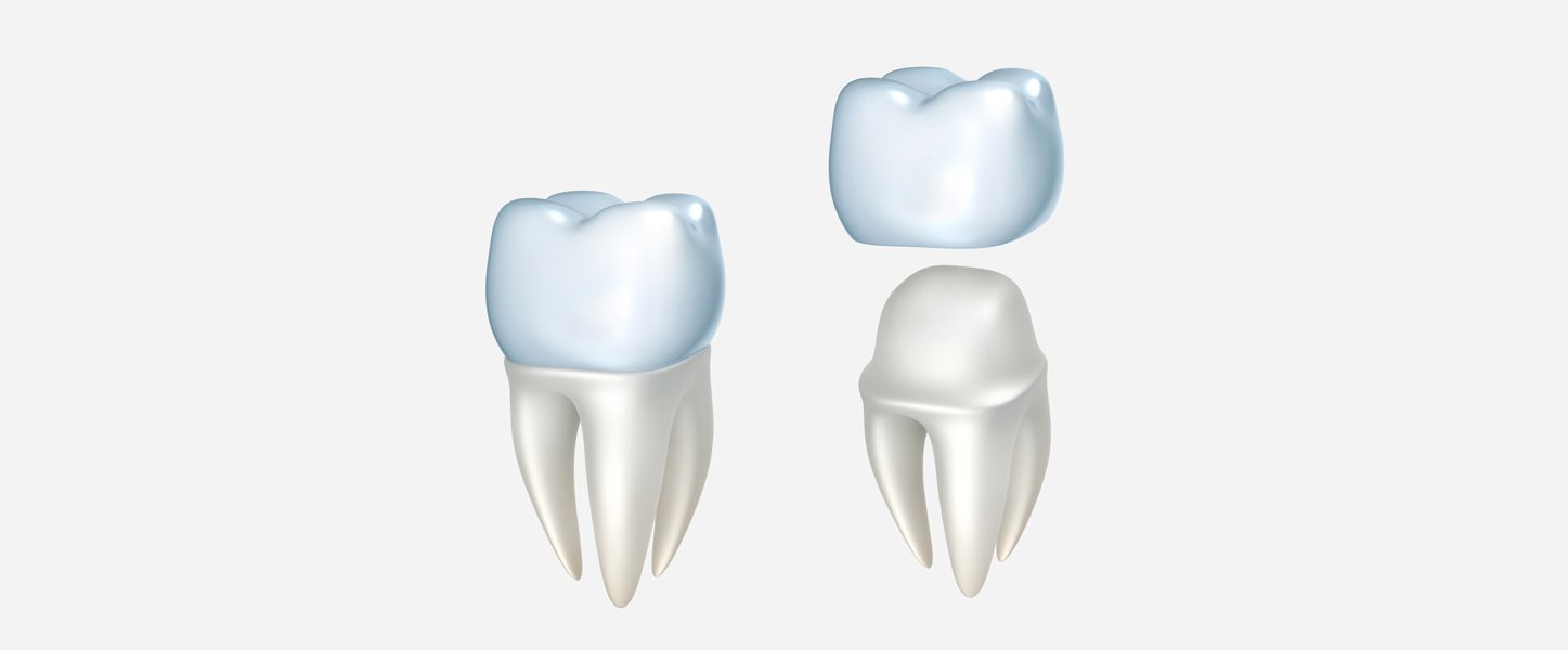 Worried About Your Dental Crown Falling Off? Here’s How to Prevent It