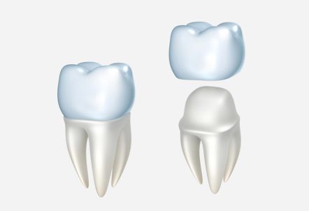 Worried About Your Dental Crown Falling Off? Here’s How to Prevent It