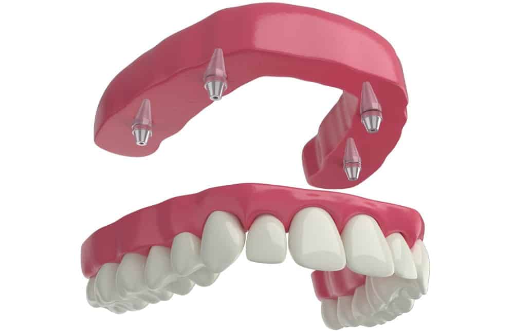 Benefits of Dental Implants
