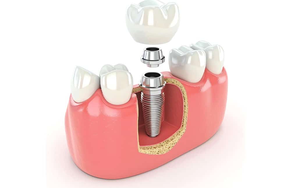 All on 4 Dental IMPLANT