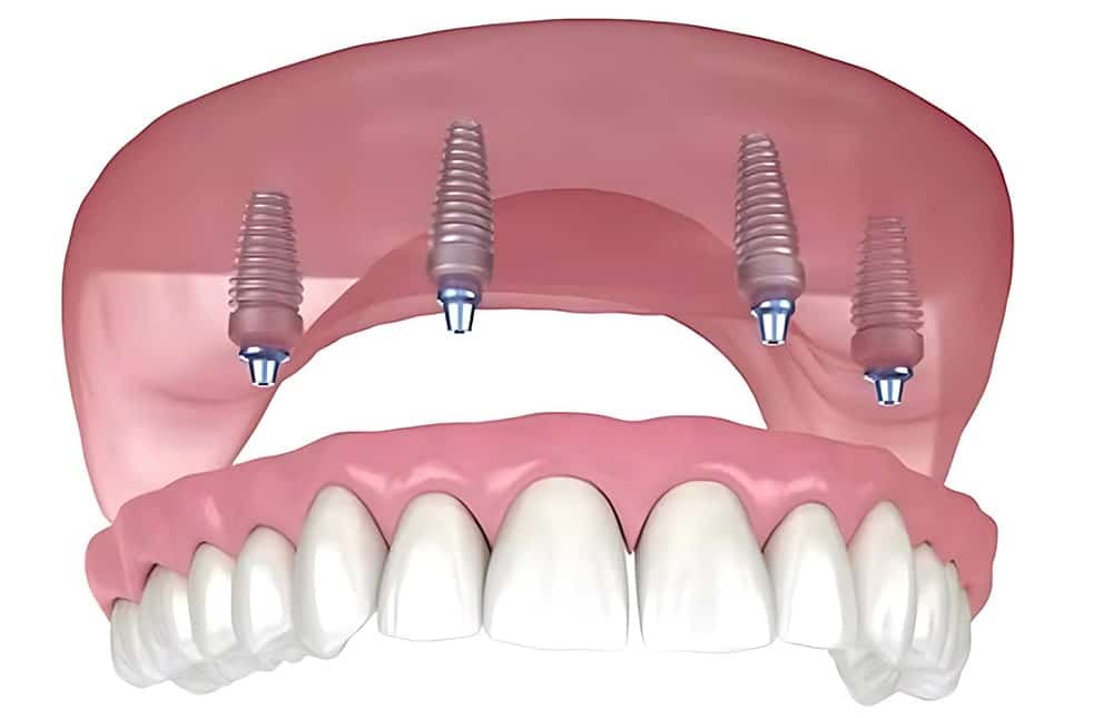 What Are Dental Implants