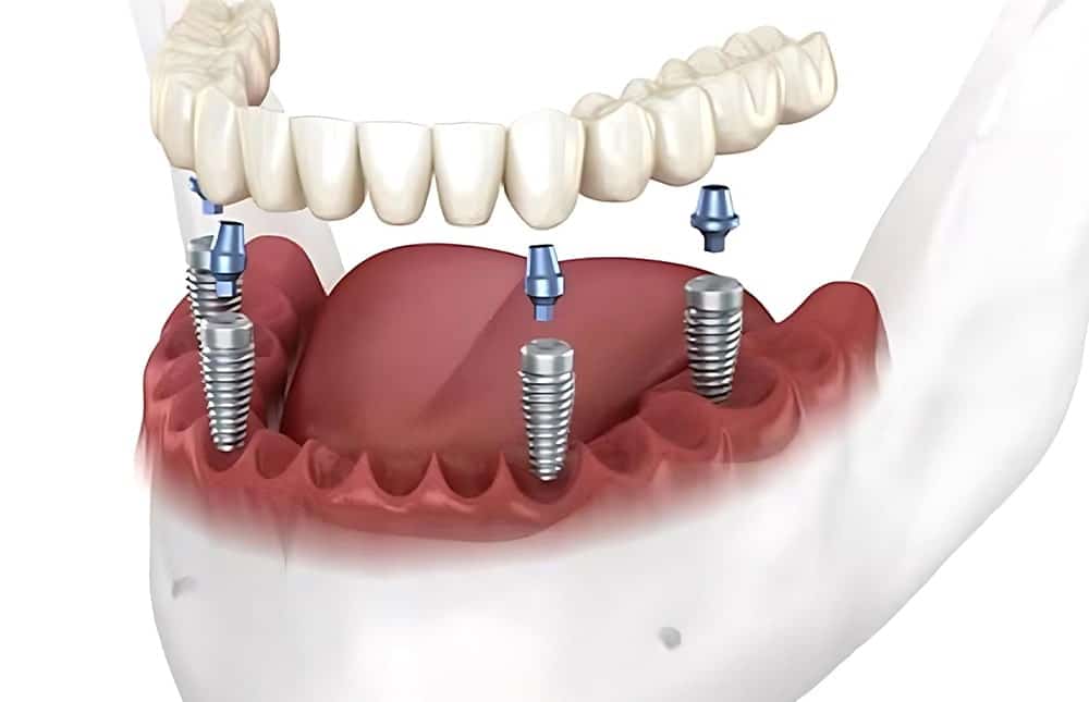 Dental Implants vs. Other Options