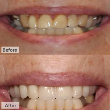 Before After Dentures