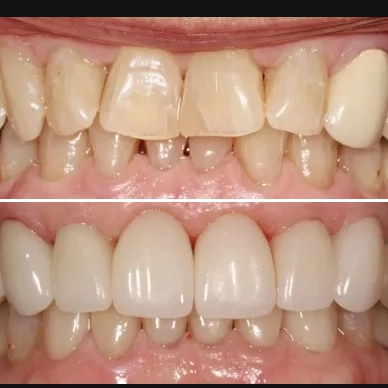Before and After - Veneers