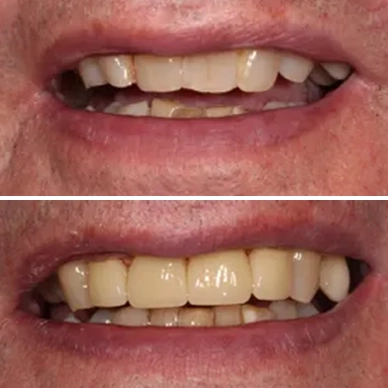 Before and After - Veneers