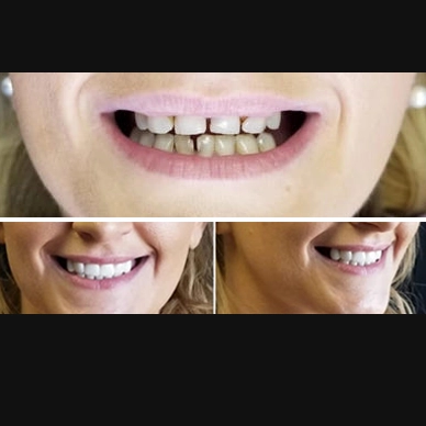 Before and After - Veneers