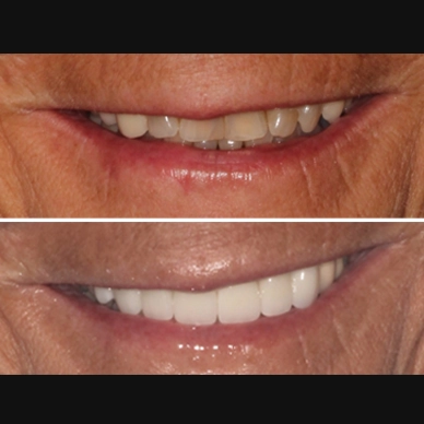 Before and After - Veneers