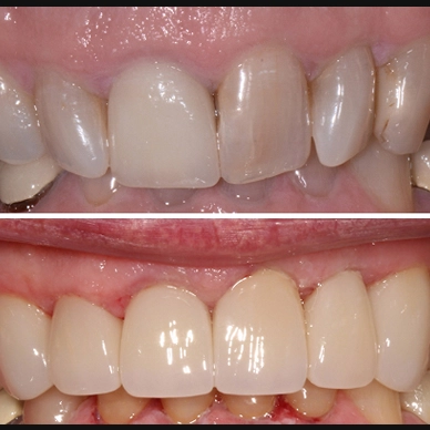 Before and After - Veneers