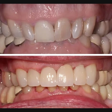 Before and After - Veneers