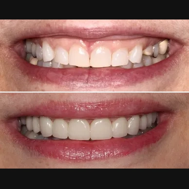 Before and After - Veneers