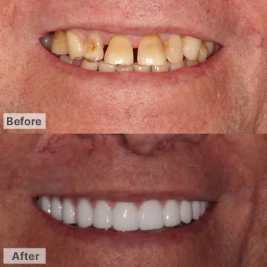 Before and After – Dentures & Implants