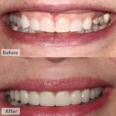 Before and After – Veneers
