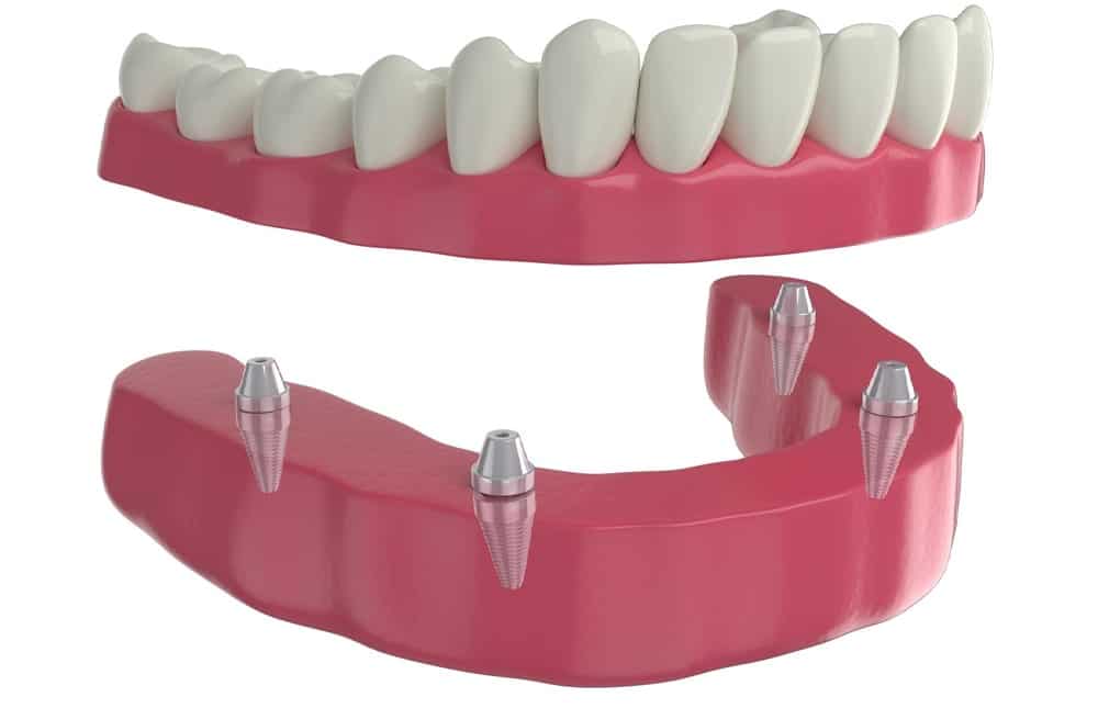 Why Choose Dental Implants?