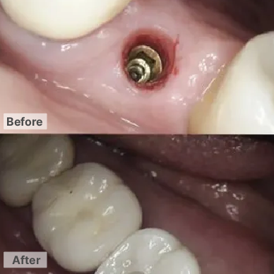 Before and After – Implants