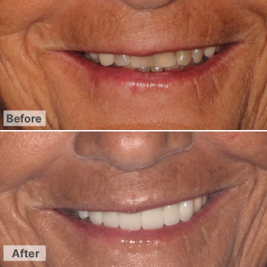 Before and After – Veneers ( full upper)