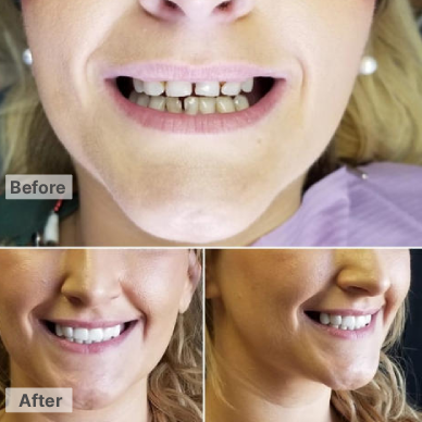 Before and After – Veneers ( full upper)