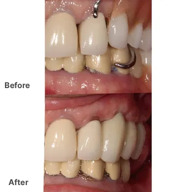 Before and After – Veneers