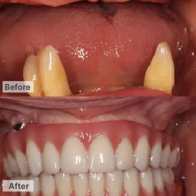 Both upper and lower - Implants