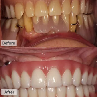 Both upper and lower - Implants