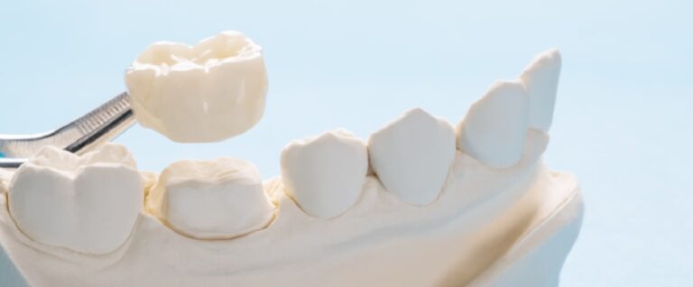 How Much Does a Dental Bridge Cost in Phoenix