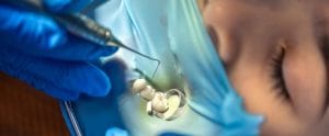 Are Composite Fillings Safe?
