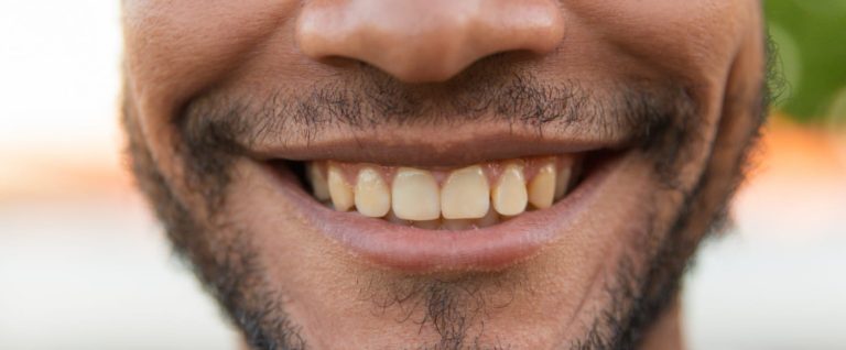 How to Get Rid of Yellow Teeth