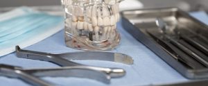 Which Is Better: All-on-4 or All-on-6 Dental Implants?